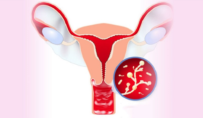 Dịch túi cùng là gì ? Nguyên nhân túi cùng có dịch và ý nghĩa của việc chẩn đoán 2
