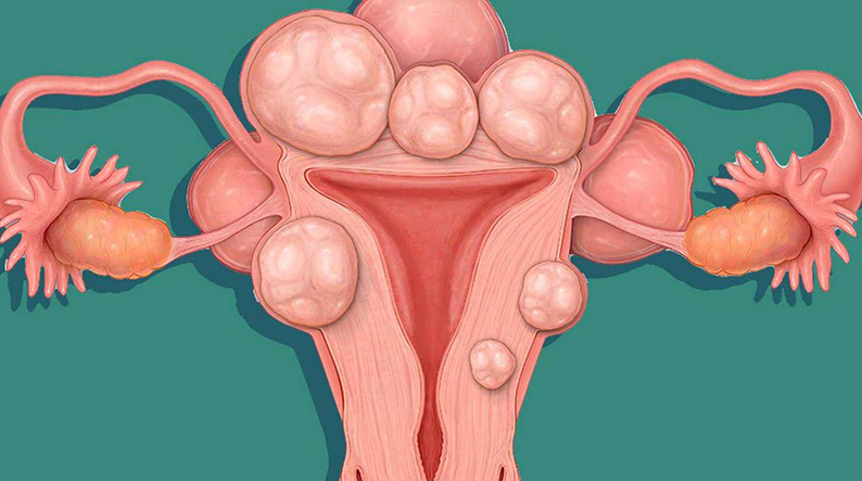Dịch túi cùng là gì ? Nguyên nhân túi cùng có dịch và ý nghĩa của việc chẩn đoán 3