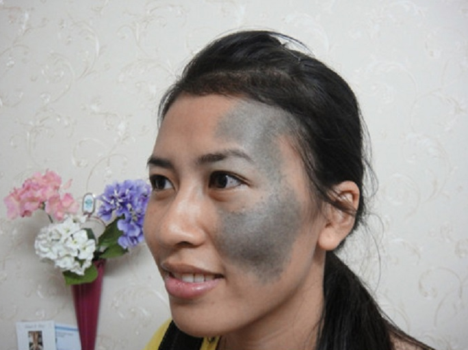 Điều trị chàm bằng laser toning và những điều cần biết 1