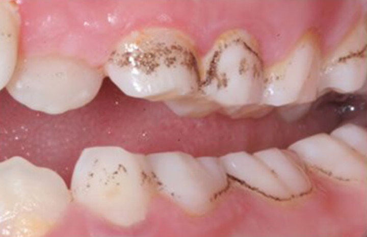 Đốm nâu trên răng là hiện tượng gì? Làm cách nào loại bỏ? 1