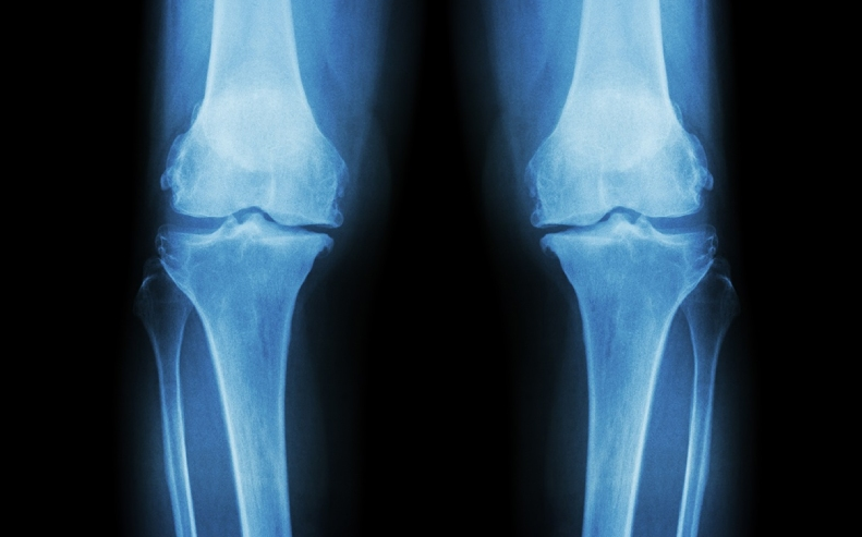 Gãy sụn tăng trưởng ở trẻ em: Nguyên nhân, triệu chứng, chẩn đoán, điều trị 1