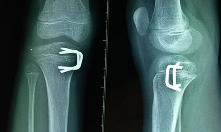 Gãy sụn tăng trưởng ở trẻ em: Nguyên nhân, triệu chứng, chẩn đoán, điều trị 3
