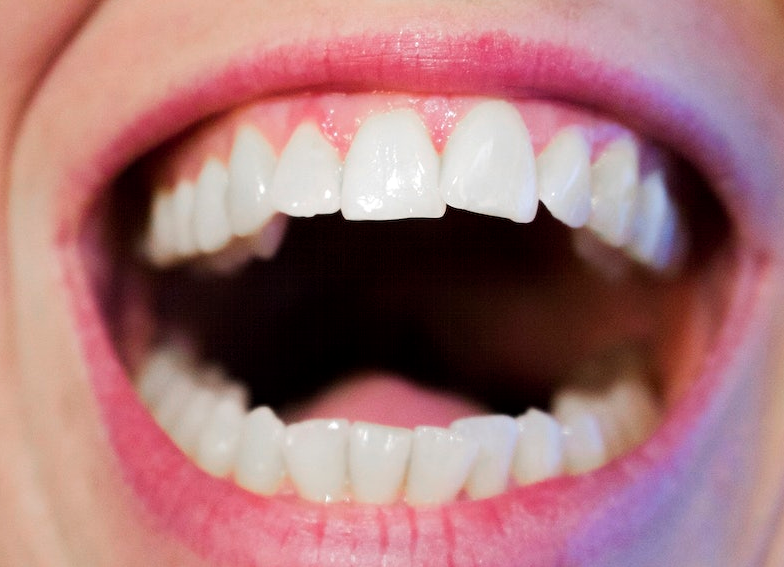 Gel làm trắng răng có thực sự tốt không? Những lưu ý khi sử dụng 3