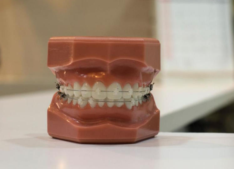 Giá niềng răng mắc cài sứ là bao nhiêu? Ưu, nhược điểm của niềng răng mắc cài sứ 1