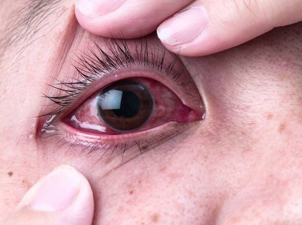 Giải đáp: Đau mắt đỏ có lây không và làm sao để điều trị? 1
