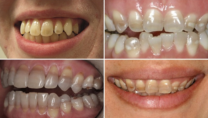 Giải đáp: Răng nhiễm kháng sinh có tẩy được không? 1