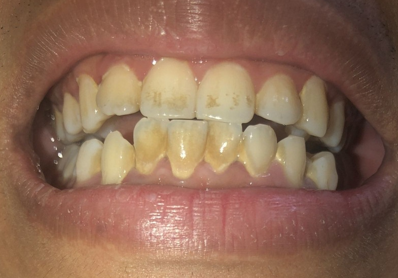 Giải đáp: Răng nhiễm kháng sinh có tẩy được không? 3