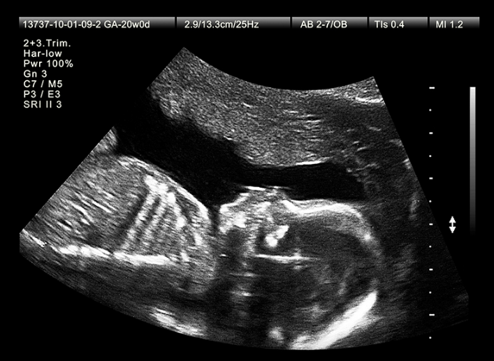 Giải đáp: Siêu âm 2d cân nặng có chuẩn không? 1
