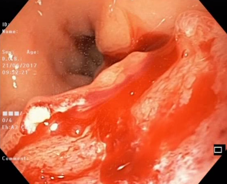 Giải đáp: Siêu âm dạ dày có cần nhịn ăn không? 2