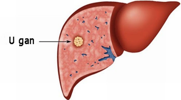 Giải đáp: Siêu âm gan có cần nhịn ăn không? 2