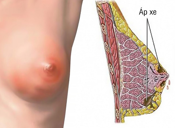 Giải đáp: Tắc tia sữa bao lâu thì bị áp xe? 1