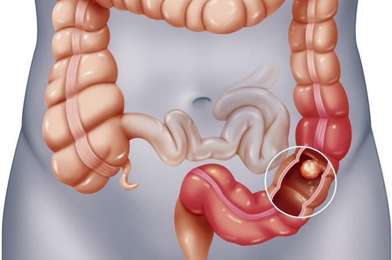 Giải đáp thắc mắc: Chữa đau đại tràng bằng mật ong có tốt không? 2