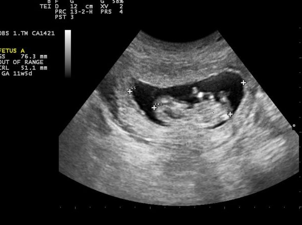 Giải đáp: Thai bao nhiêu tuần thì siêu âm thấy túi thai? 1