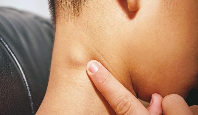 Sưng hạch bạch huyết ở cổ là bệnh gì? 2