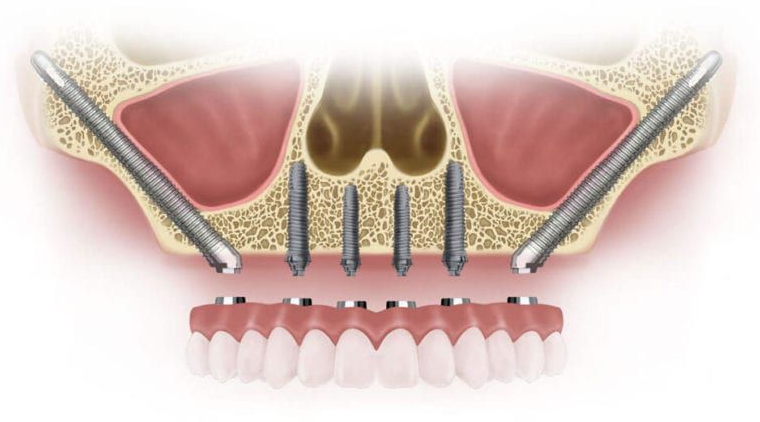 Hàm tháo lắp trên Implant là gì? Ưu, nhược điểm và các lưu ý khi sử dụng 2
