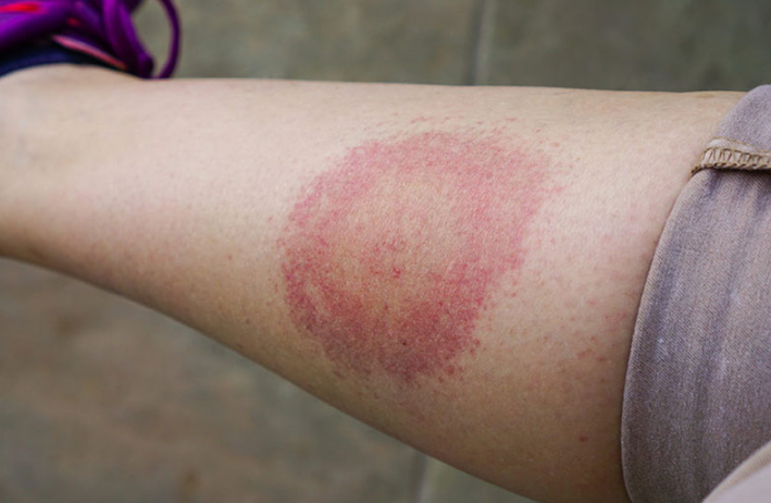 Hiện tượng bị nổi vòng tròn đỏ trên da là do bệnh lý? 2