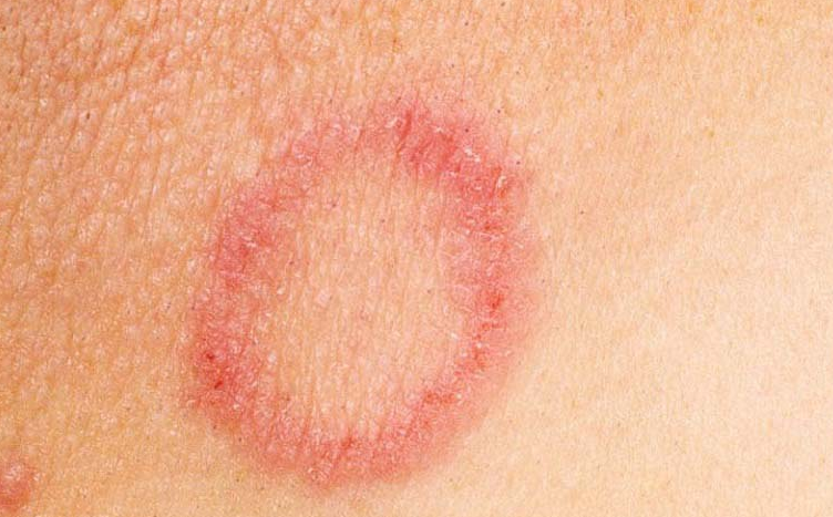 Hiện tượng bị nổi vòng tròn đỏ trên da là do bệnh lý? 3