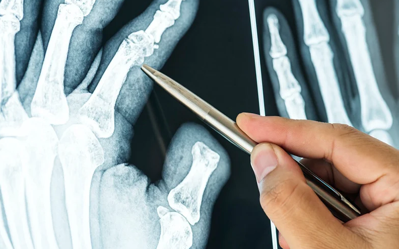 Hiểu cơ chế viêm khớp dạng thấp để kiểm soát bệnh hiệu quả 3