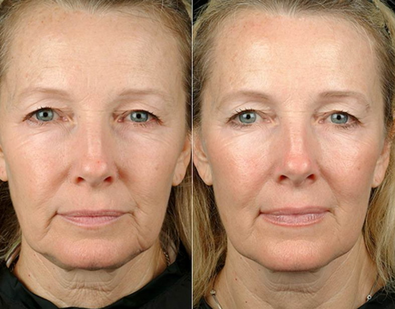 Hifu và Thermage: Phương pháp nâng cơ, trẻ hóa da nào tốt? 4