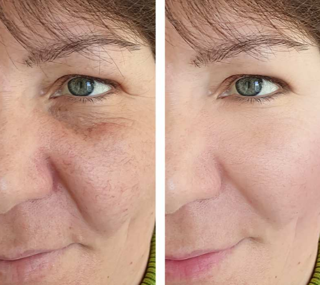 Hifu và Thermage: Phương pháp nâng cơ, trẻ hóa da nào tốt? 3