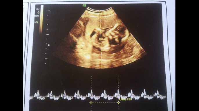 Hình ảnh siêu âm thai 7 tuần tuổi quan trọng như thế nào? 3