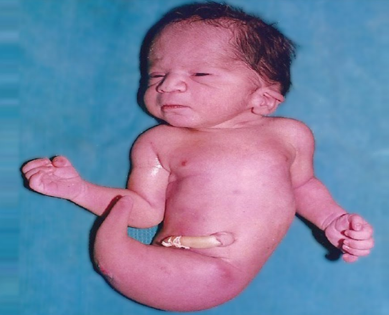 Hội chứng người cá: Dị tật bẩm sinh hiếm gặp 1
