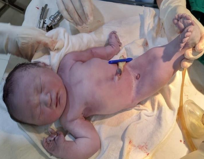 Hội chứng người cá: Dị tật bẩm sinh hiếm gặp 2