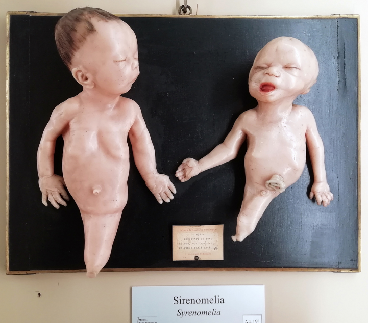 Hội chứng người cá: Dị tật bẩm sinh hiếm gặp 3