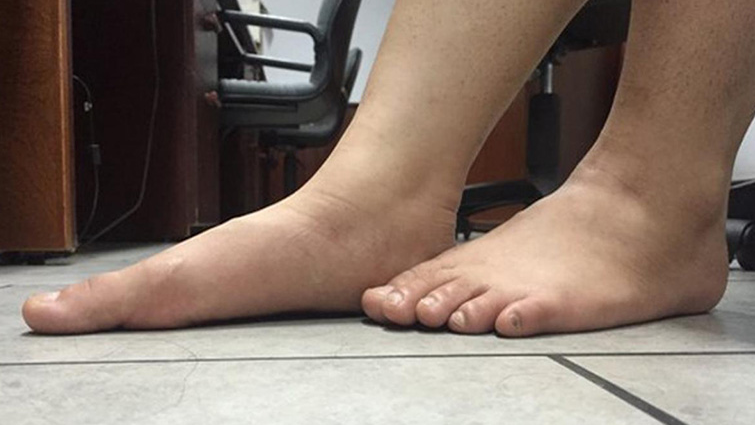 Hướng dẫn vật lý trị liệu cho trẻ có bàn chân bẹt 1