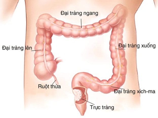 Kết tràng là gì? Các bệnh lý thường gặp ở kết tràng và cách phòng chống? 1