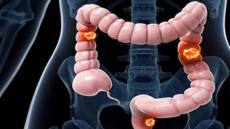 Kết tràng là gì? Các bệnh lý thường gặp ở kết tràng và cách phòng chống? 2