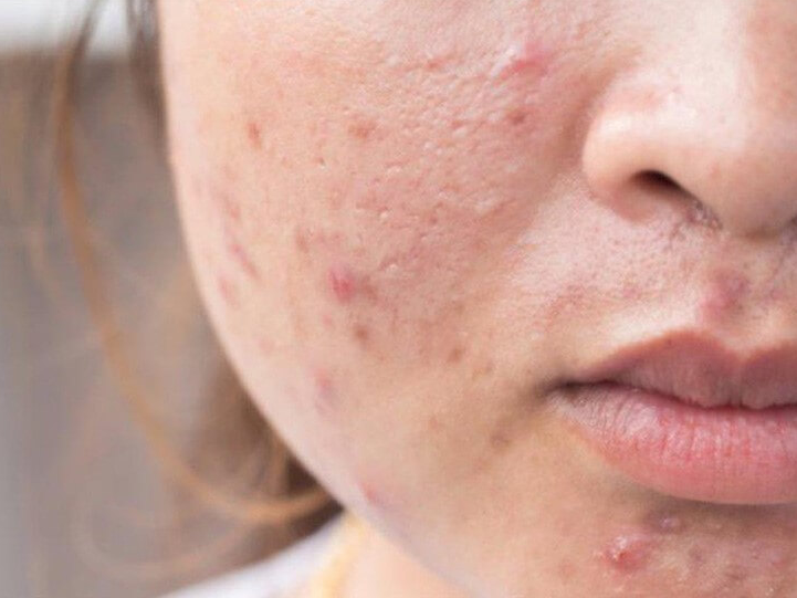 L70 trứng cá: Dấu hiệu nhận biết và cách điều trị hiệu quả 1