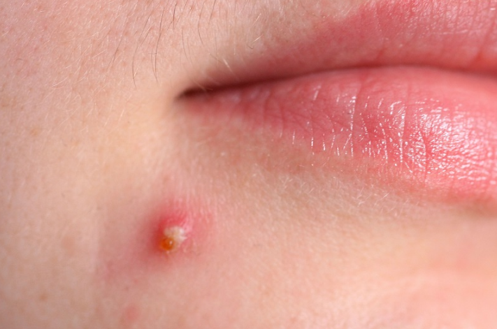 L70 trứng cá: Dấu hiệu nhận biết và cách điều trị hiệu quả 3