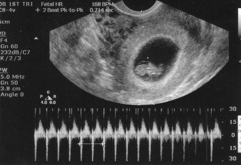 Mách mẹ cách nhận biết dấu hiệu thai 6 tuần khỏe mạnh 3