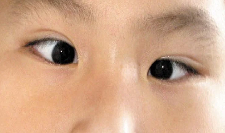 Mắt hiếng là gì? Tác hại với sức khỏe và cách điều trị 2