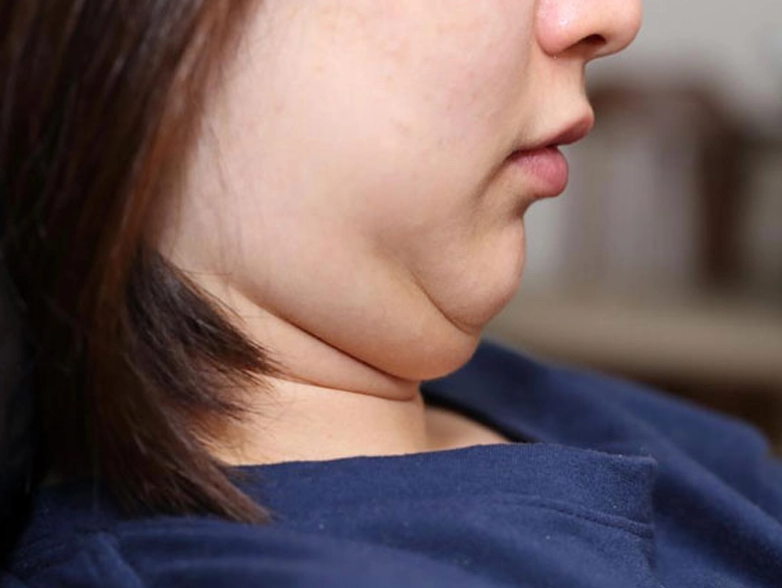 Nâng cơ xóa nọng cằm là phương pháp gì? 1