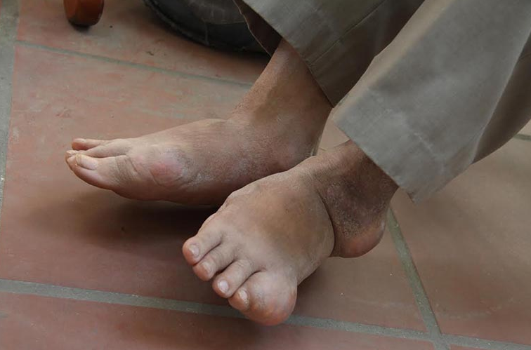 Ngón chân út bị sưng đau là do đâu? Cách điều trị thế nào? 1