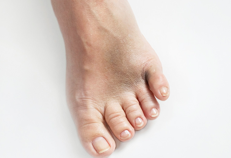 Ngón chân út bị sưng đau là do đâu? Cách điều trị thế nào? 2