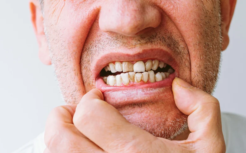 Người 60 tuổi có nên trồng răng không? Phương pháp trồng răng nào an toàn, hiệu quả? 1