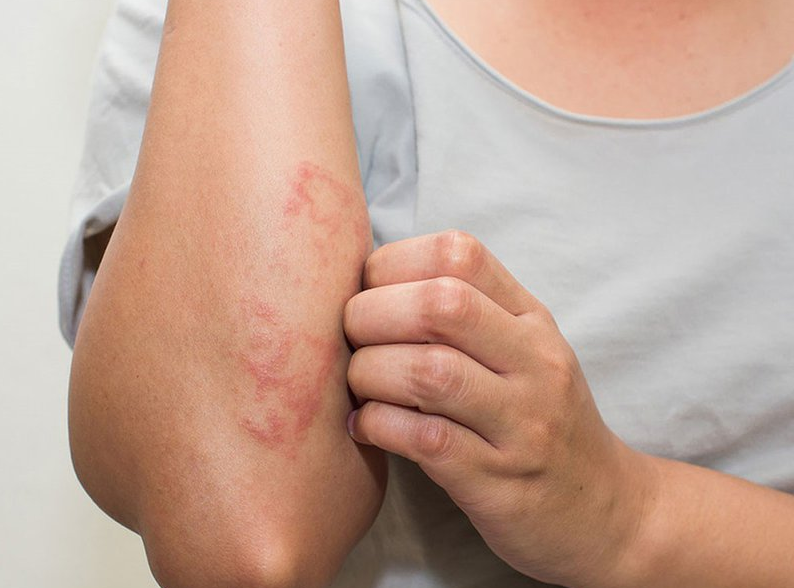 Người bị zona thần kinh có quan hệ được không? 1