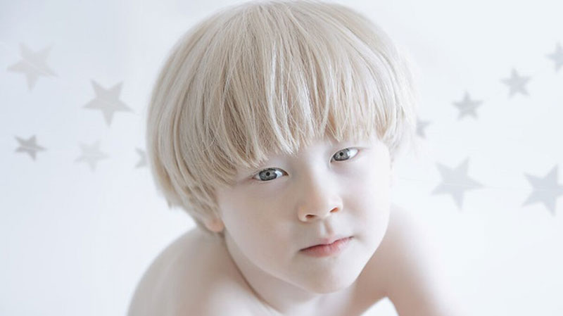 Nguyên nhân và cách điều trị rối loạn sắc tố da ở trẻ em 3