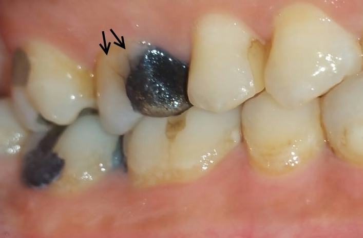 Nhai 1 bên bị lệch mặt làm sao khắc phục? 1
