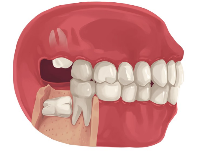 Nhai 1 bên bị lệch mặt làm sao khắc phục? 2