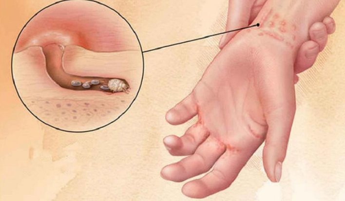 Nhận biết các dấu hiệu bị ghẻ và cách điều trị hiệu quả? 2