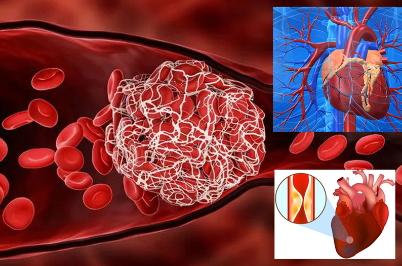 Nhận diện sốc tim trong nhồi máu cơ tim để xử lý kịp thời, hiệu quả 4