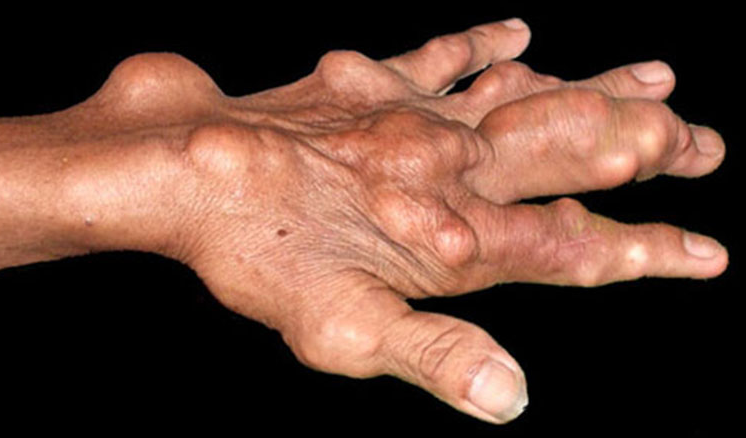 Nhiễm trùng hạt Tophi là gì? Có nguy hiểm không và cách điều trị thế nào? 2