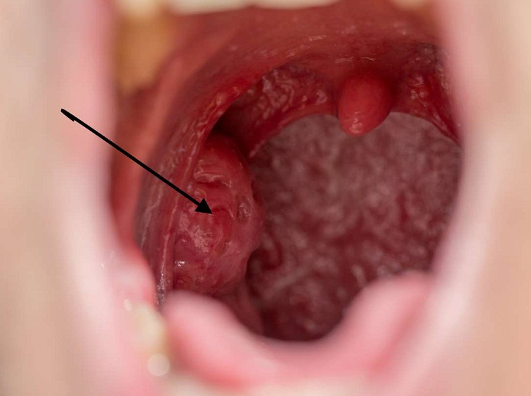 Nhiệt miệng trong cổ họng: Nguyên nhân, triệu chứng và cách xử trí 3