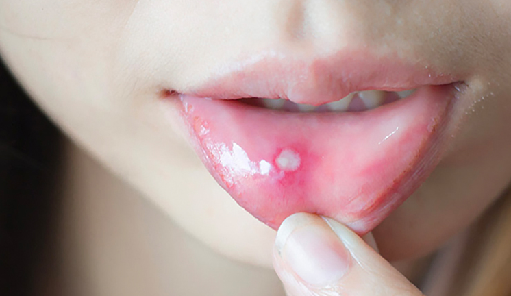 Nhiệt miệng uống nước ép gì giúp mau lành vết loét? 1