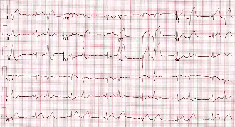 Nhồi máu cơ tim tương đương ST chênh lên là gì? Các dạng cần biết và cách chẩn đoán phân biệt 4