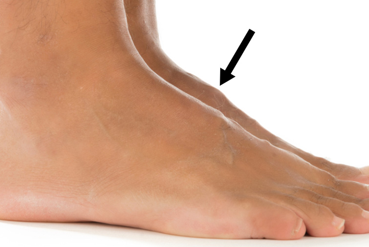 Nổi cục ở mu bàn chân do bệnh lý gì, cách điều trị ra sao? 1